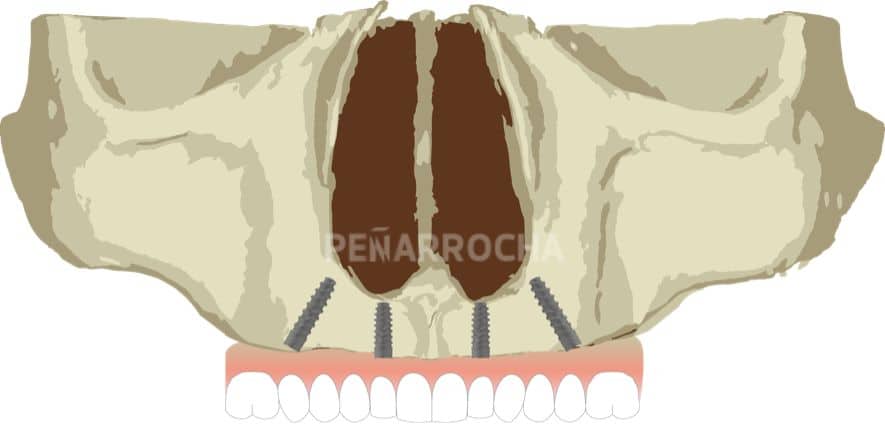 implantes all on four angulados tecnica implantes sin hueso idim clinica de implantes dentales en valencia