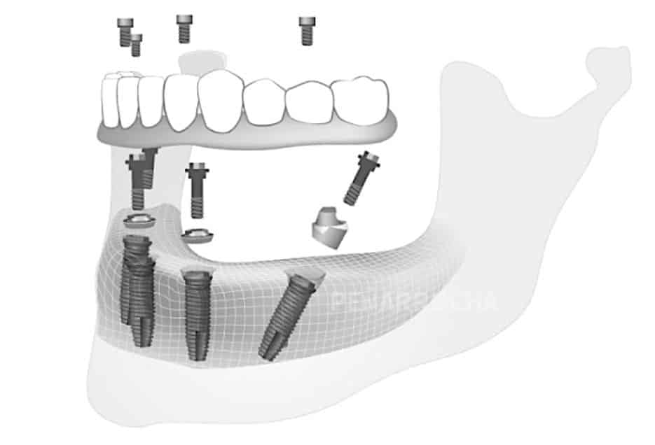 implantes all on four tecnica implantes sin hueso idim clinica de implantes dentales en valencia