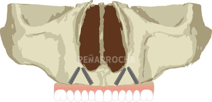 implantes angulados tecnica implantes sin hueso idim clinica de implantes dentales en valencia