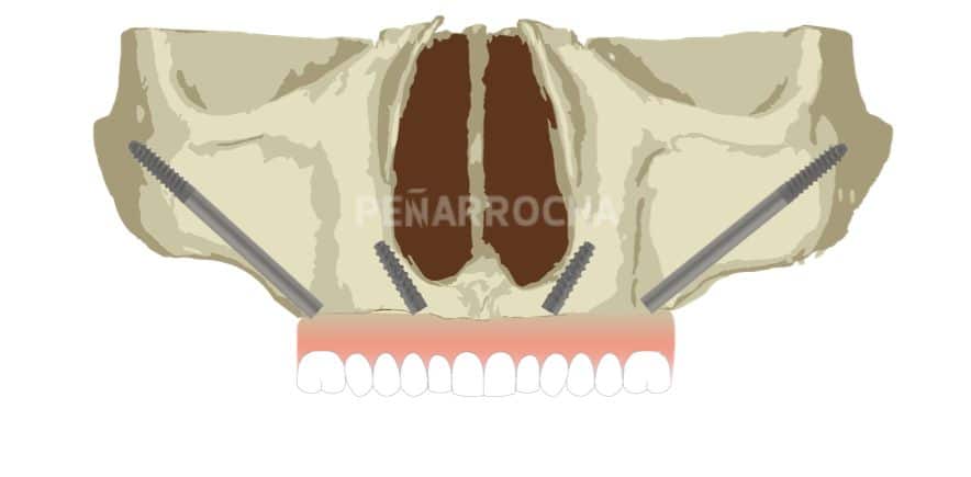 implantes cigomaticos 1 tratamiento implantes sin hueso idim clinica de implantes dentales en valencia