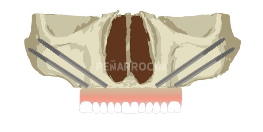 implantes cigomaticos 3 tratamiento implantes sin hueso idim clinica de implantes dentales en valencia