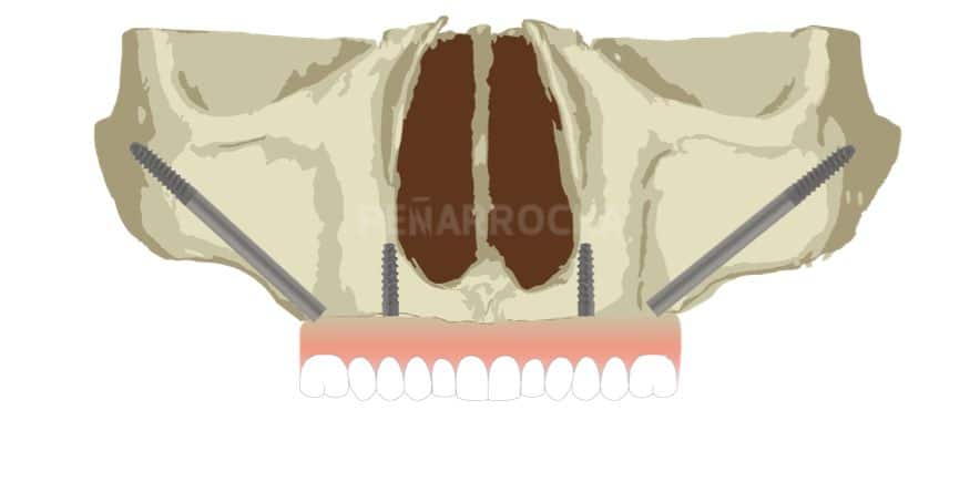 implantes cigomaticos 4 tratamiento implantes sin hueso idim clinica de implantes dentales en valencia