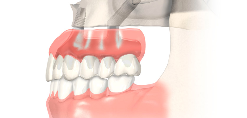 Implantes dentales cigomáticos en Valencia Zygomatic implants in Valencia