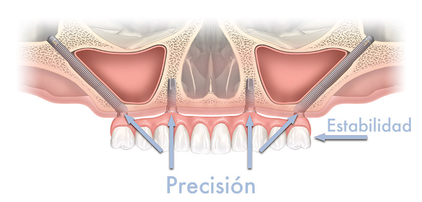 Implantes cigomáticos Example of zygomatic implants