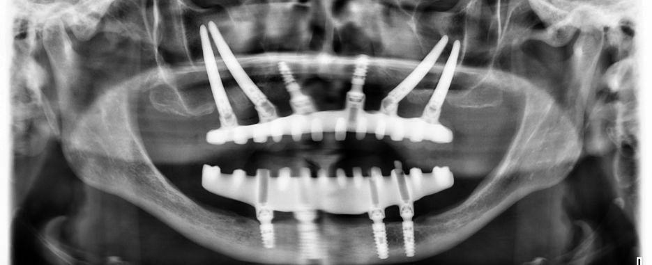 implantes dentales para pacientes que tienen falta de hueso