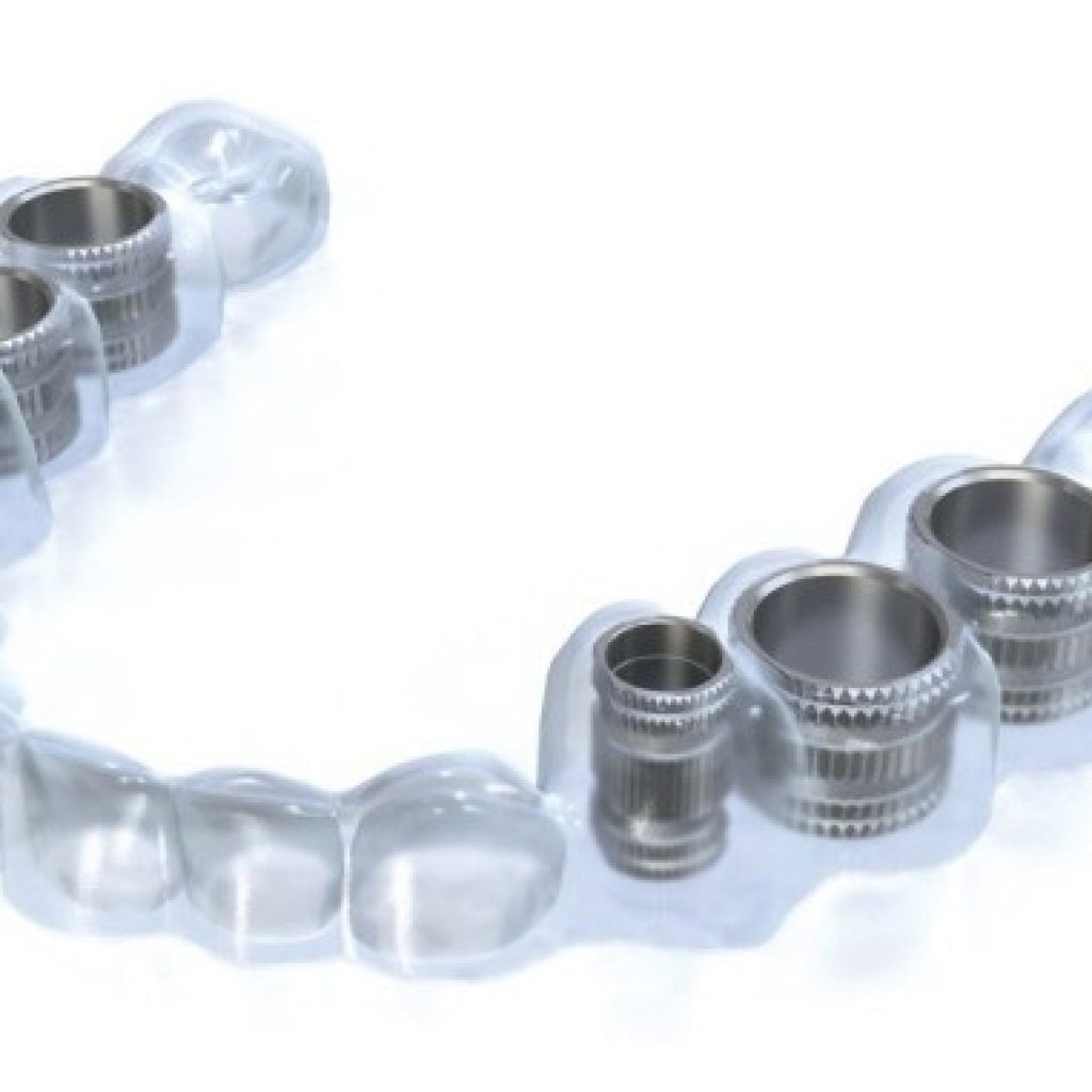 implantes dentales sin cirugia en Valencia