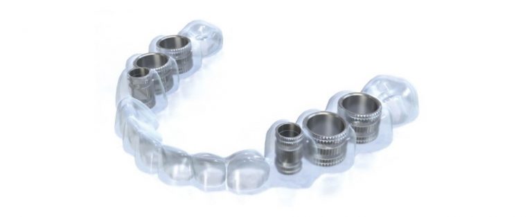 implantes dentales sin cirugia en Valencia