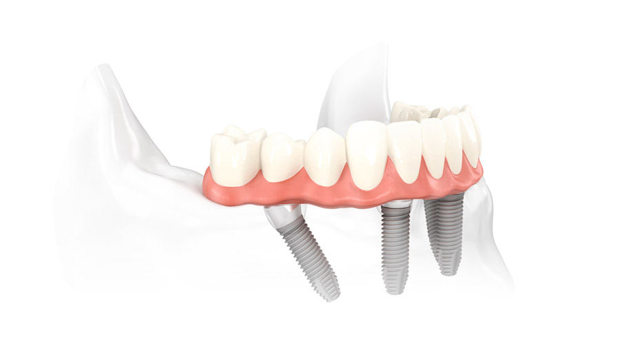 Implantes inclinados en clínica especializada en implantología Implantes inclinados clínica especializada