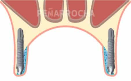 implantes palatinizados 2 tratamiento implantes sin hueso idim clinica de implantes dentales en valencia