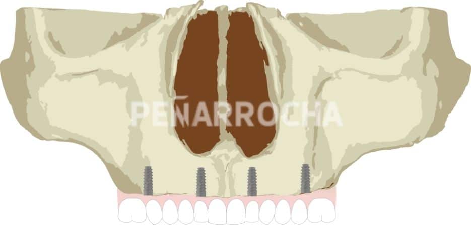 implantes palatinizados tratamiento implantes sin hueso idim clinica de implantes dentales en valencia