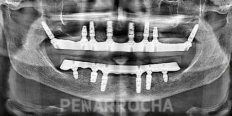 implantes pterigoideos tratamiento implantes sin hueso idim clinica de implantes dentales en valencia