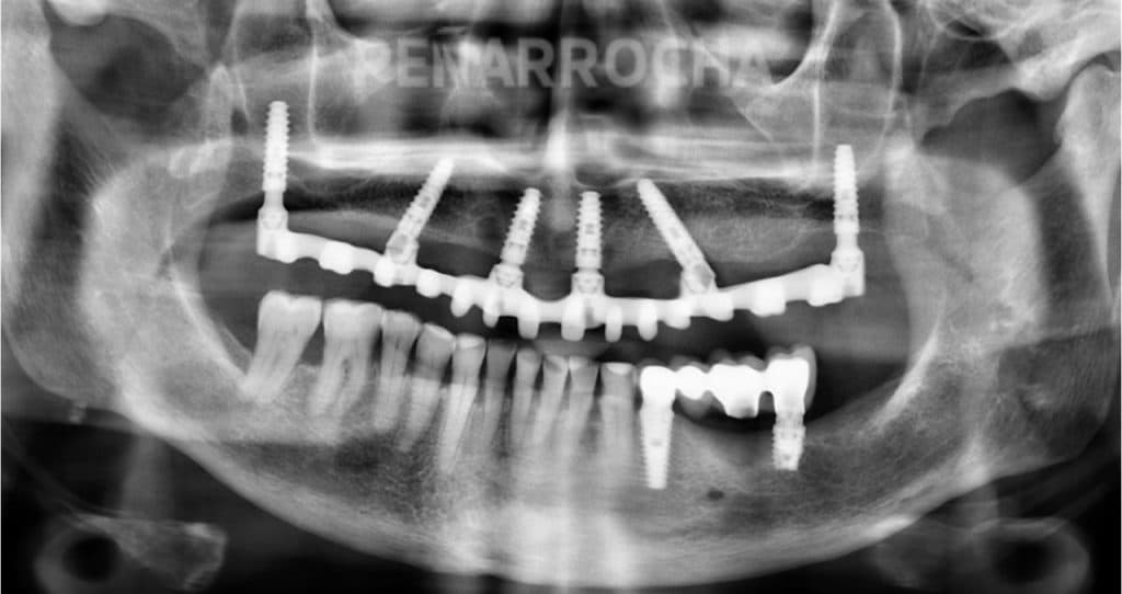 implantes pterigoideos2 tratamiento implantes sin hueso idim clinica de implantes dentales en valencia