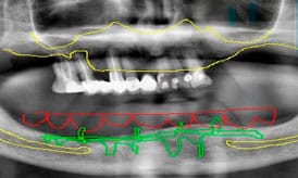 implantes subperiósticos antes 2
