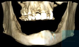 implantes subperiósticos antes3