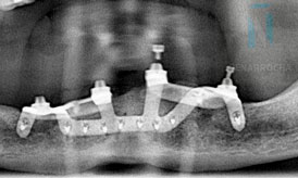 implantes subperiósticos despues 3