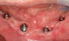 implantes subperiósticos despues 2