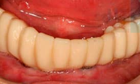implantes subperiósticos despues3