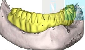 implantes subperiósticos proceso 3