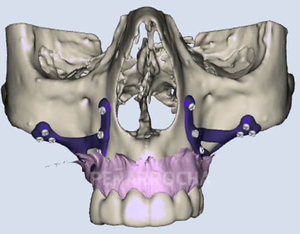 implantes subperiosticos tratamiento implantes sin hueso idim clinica de implantes dentales en valencia