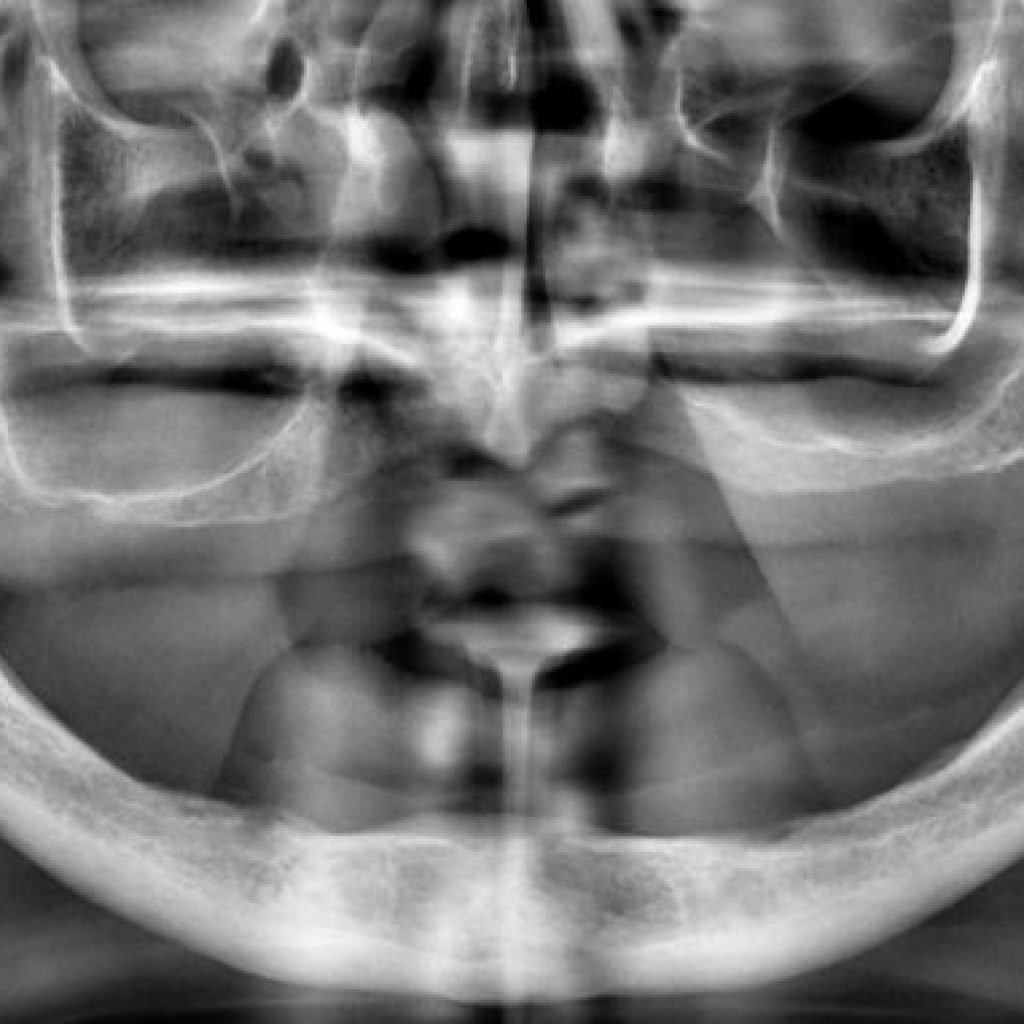 implantologia dental en pacientes con poco hueso