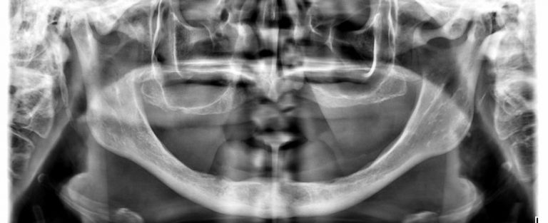 implantologia dental en pacientes con poco hueso