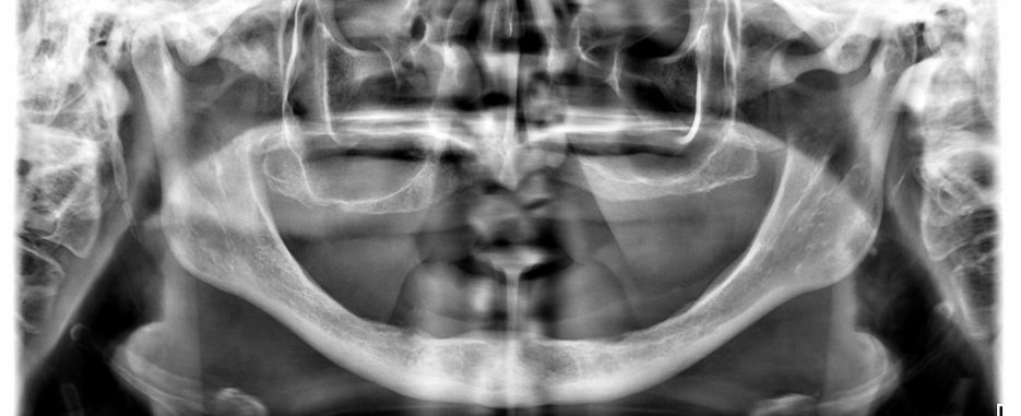 implantologia dental en pacientes con poco hueso