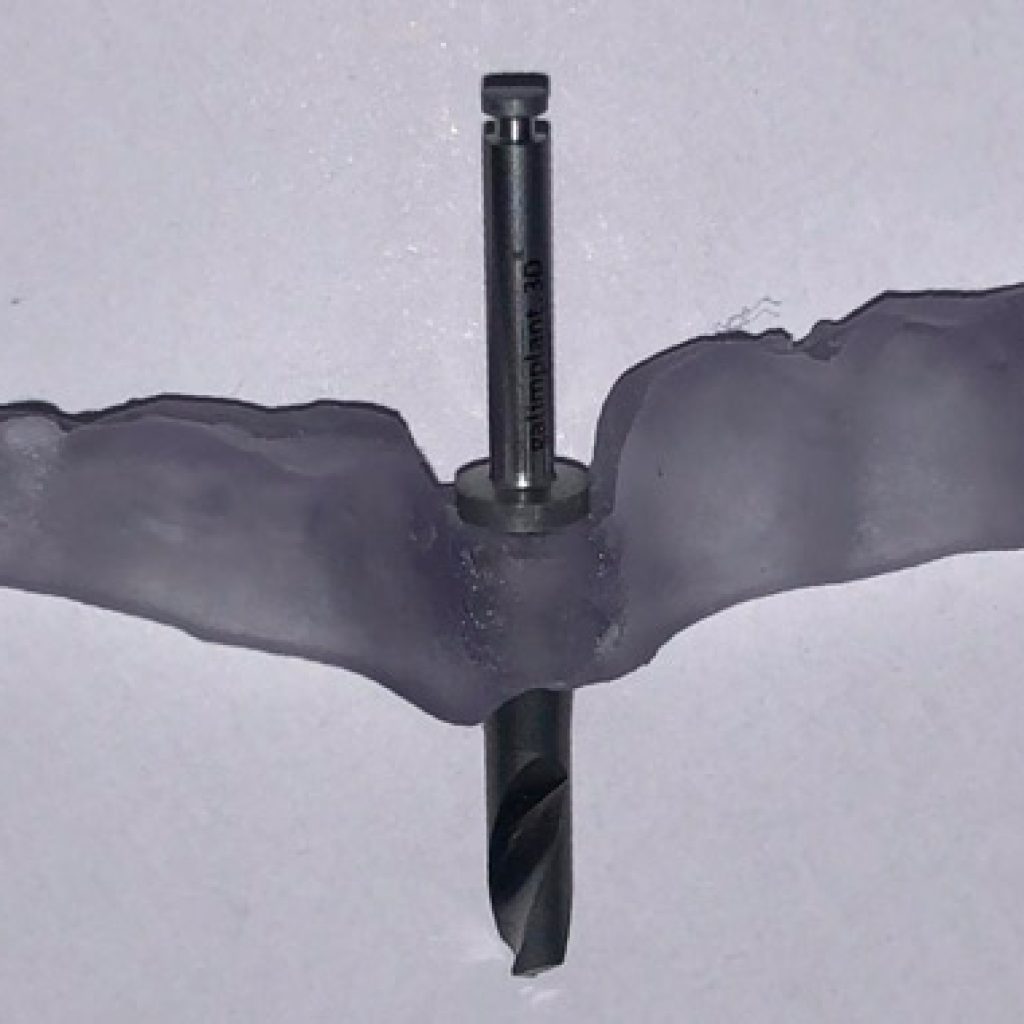 impresion 3d de ferulas y guias quirurgicas en implantologia