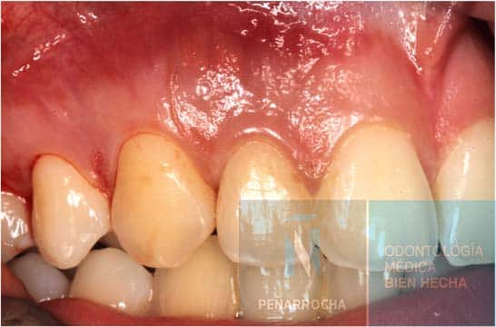 inflammation symptom of failed root canal idim dental implant clinic in valencia