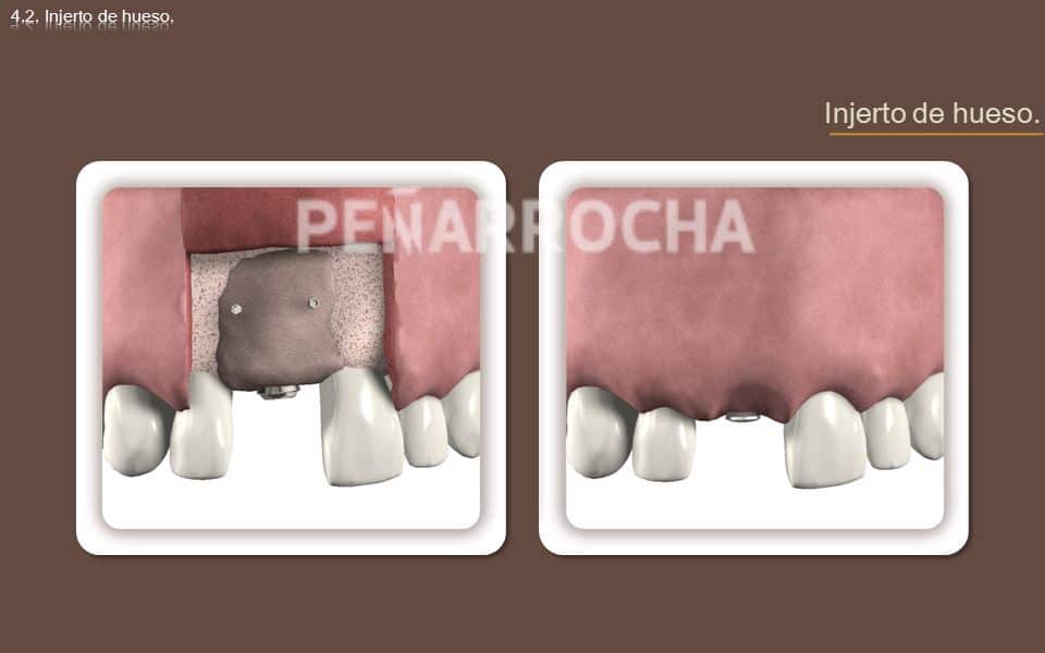 injerto de hueso tratamiento implantes sin hueso IDIM clinica de implantes dentales en valencia