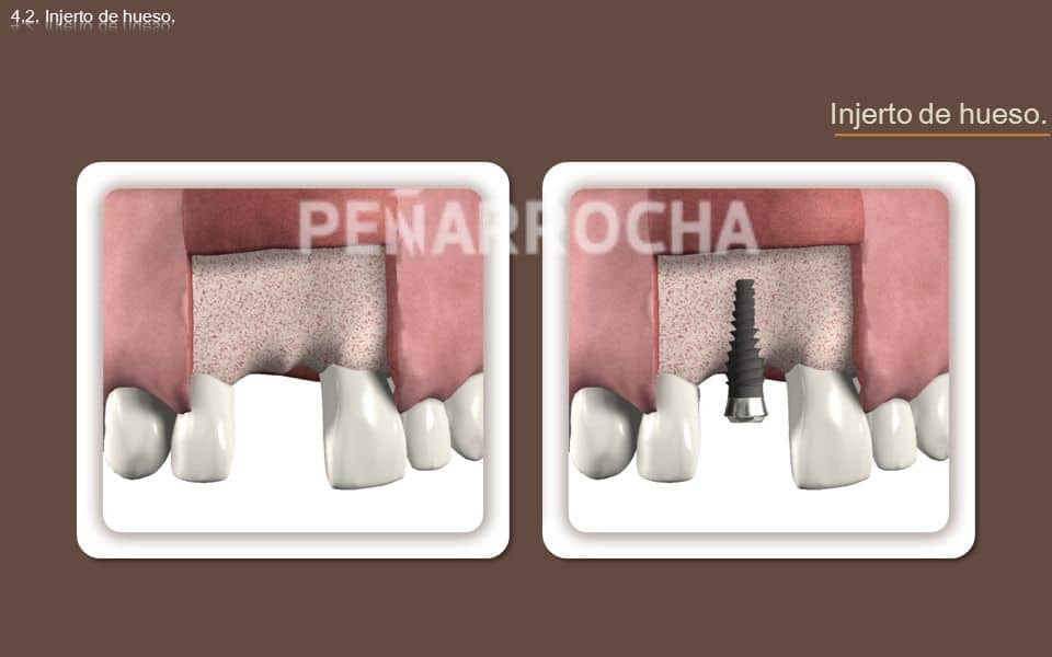 injerto oseo tratamiento implantes sin hueso idim clinica de implantes dentales en valencia