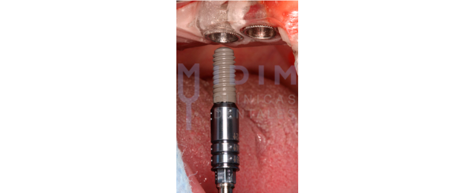 inserción de implante dental con ferula guiada insercion de implante dental con ferula guiada