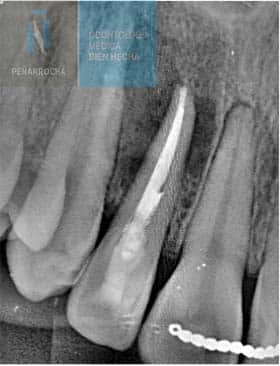 lesion radiotransparente endodoncia mal hecha idim clinica de implantes dentales en valencia 