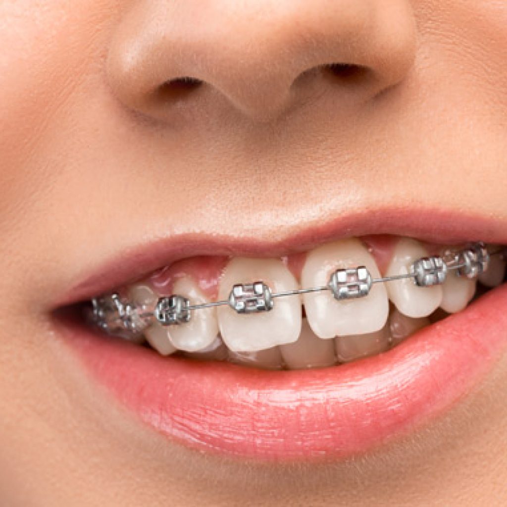 limar dientes o stripping dental