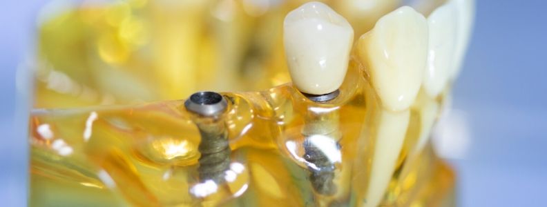 tipos de carga protesica en implantologia dental