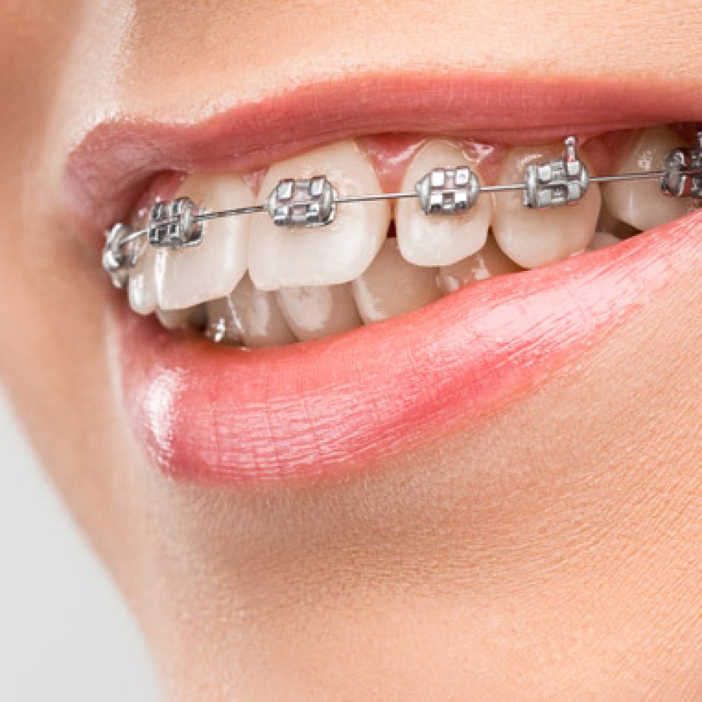 maloclusion tipos sintomas tratamientos