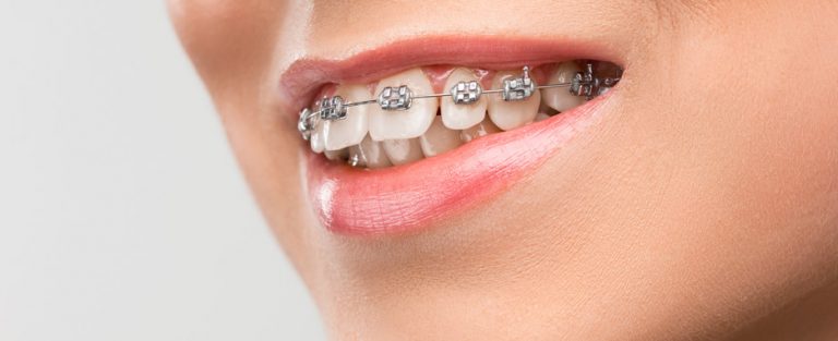 maloclusion tipos sintomas tratamientos