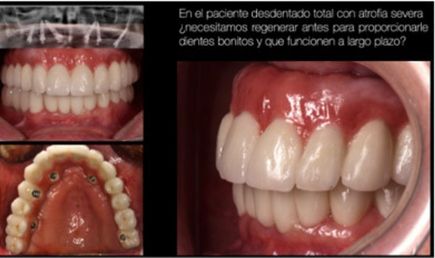 paciente desdentado total con atrofia severa