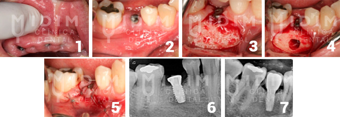 caso clinico periimplantitis temprana caso clinico patologia periapical al implante