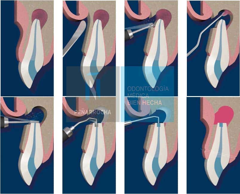 periapical surgery process in treatment after root canal failure idim dental implant clinic in valencia