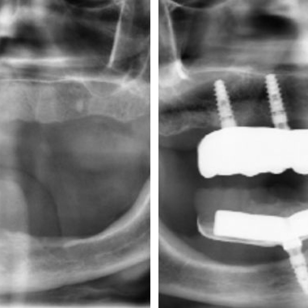 poco hueso maxilar por que se produce la atrofia maxilar IDIM clinica implantes dentales valencia
