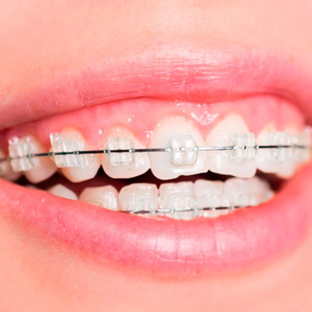 por que se despegan los brackets