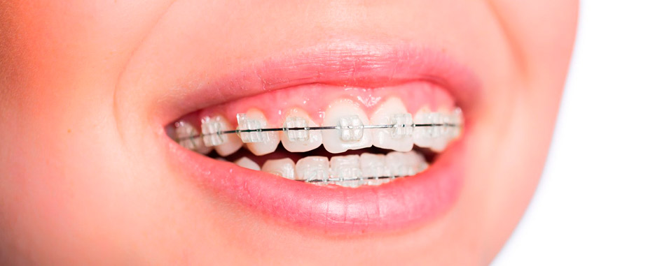 por que se despegan los brackets