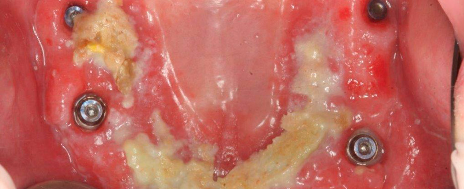 que es la candidiasis oral por que se produce la candidiasis oral