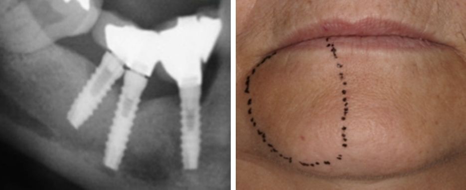 por que se produce una parestesia dental