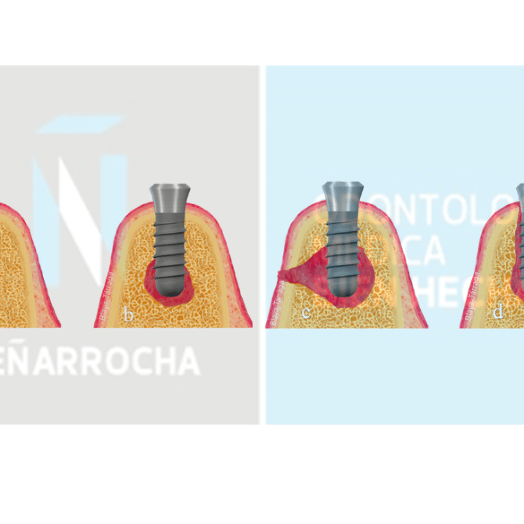 portada fracaso de implantes dentales causas tratamientos idim clinica de implantes dentales en valencia