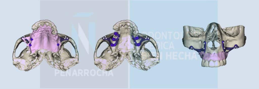portada implantes dentales sin tornillos idim clinica de implantes dentales en valencia