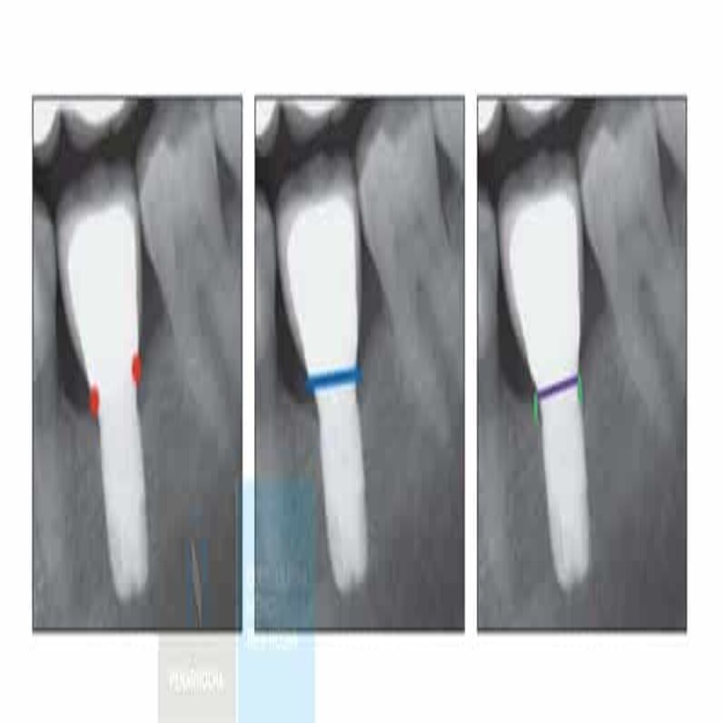 portada implantes inmediatos idim clinica de implantes dentales en valencia