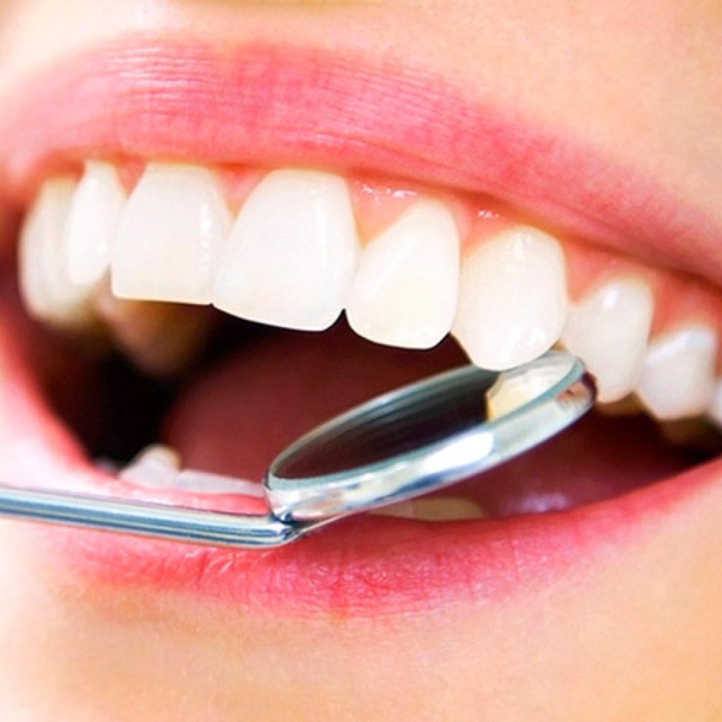 Prevenir la periimplantitis