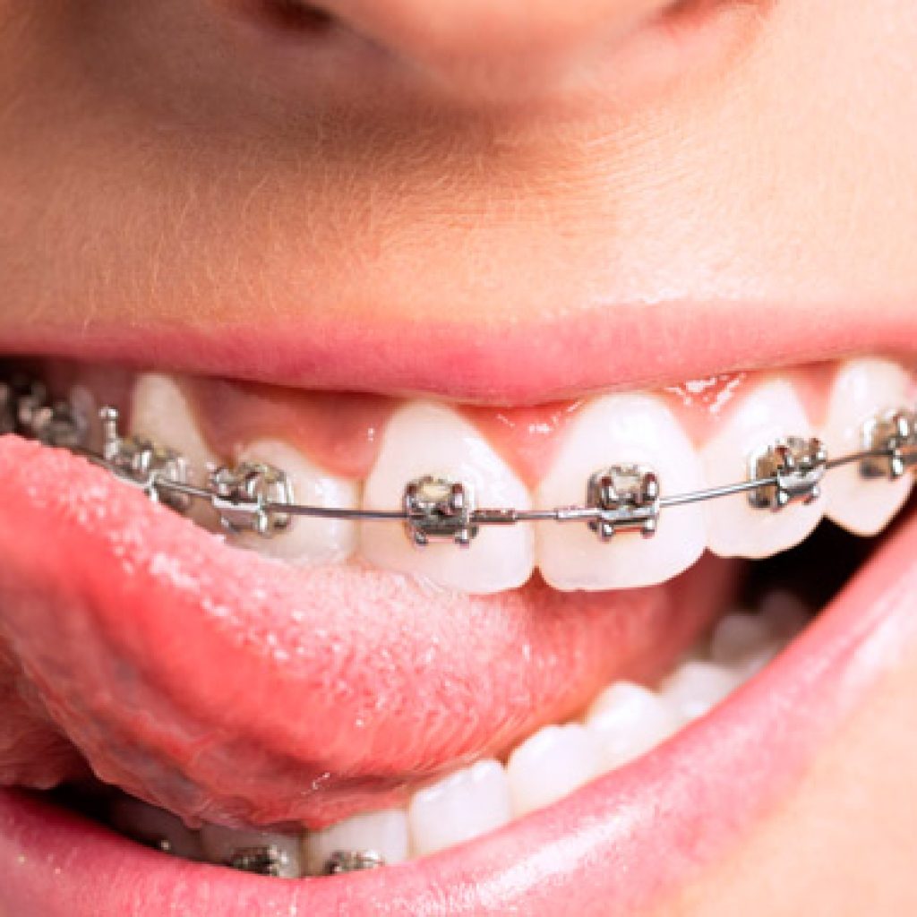 que comer con brackets recien puestos