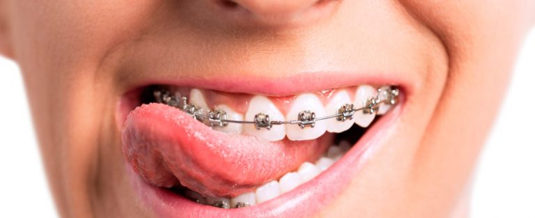 que comer con brackets recien puestos